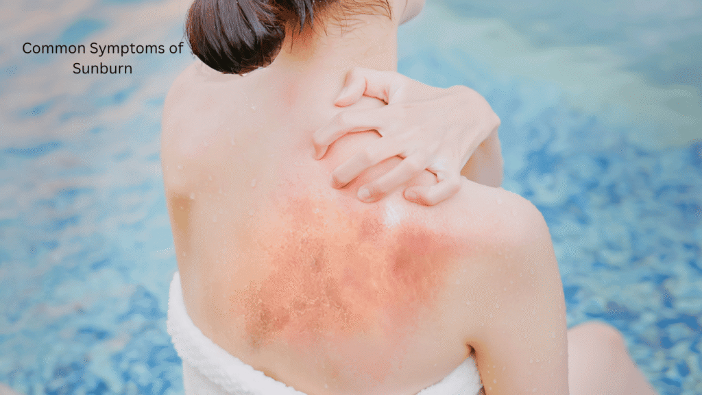 Common Symptoms of Sunburn