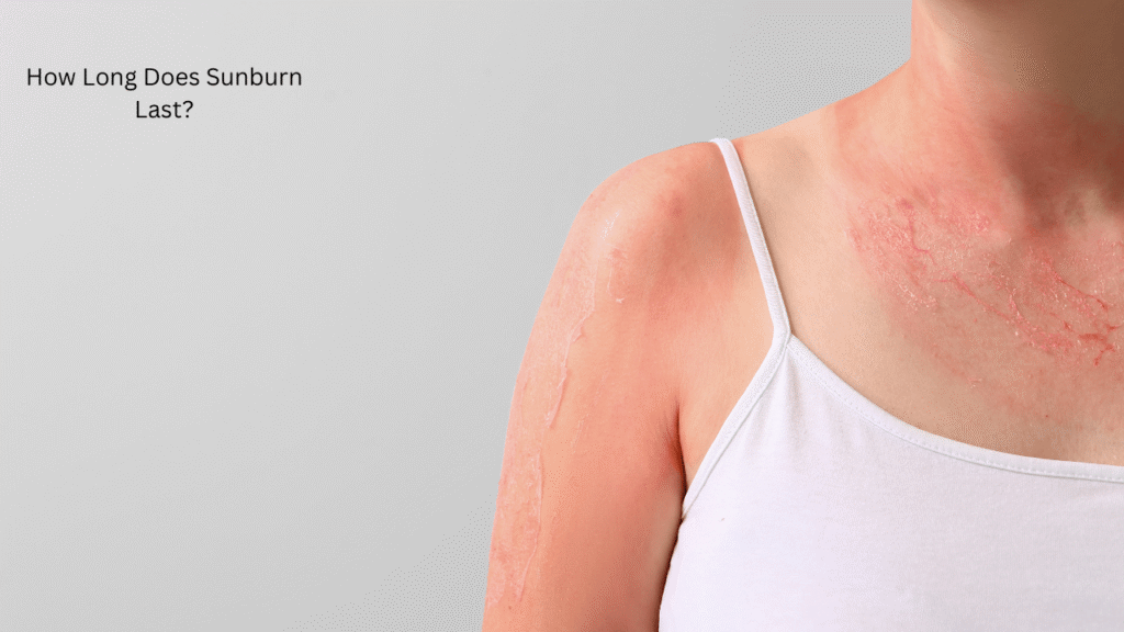 How Long Does Sunburn Last?