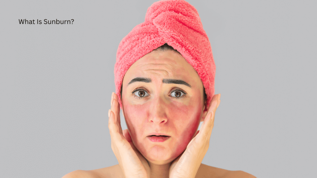 What Is Sunburn?